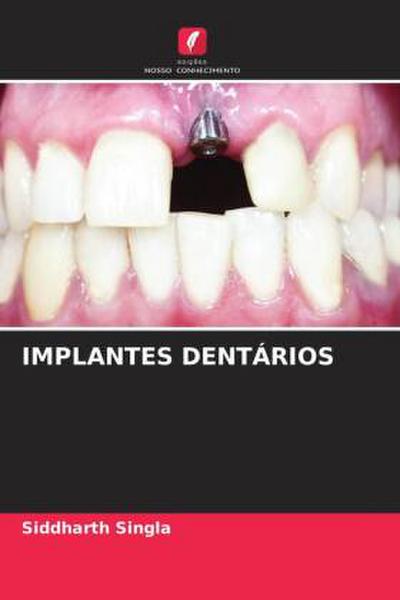 IMPLANTES DENTÁRIOS