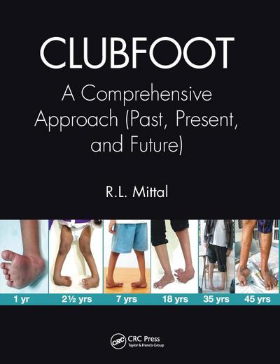 Clubfoot