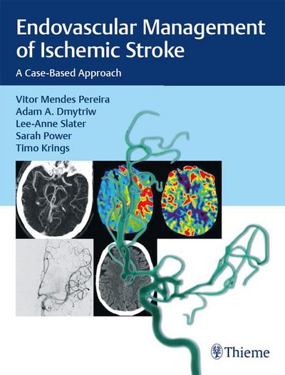 Endovascular Management of Ischemic Stroke