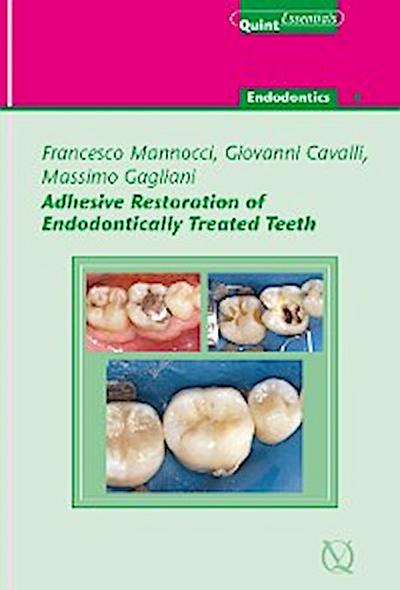Adhesive Restoration of Endodontically Treated Teeth