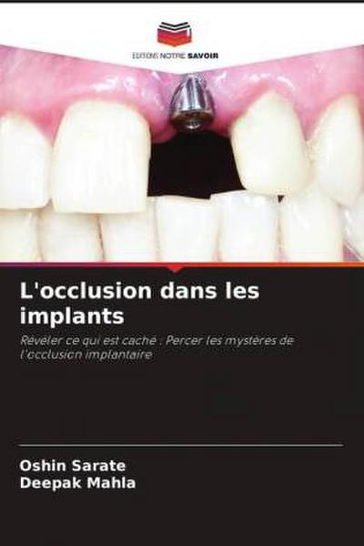 L’occlusion dans les implants