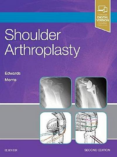 Shoulder Arthroplasty
