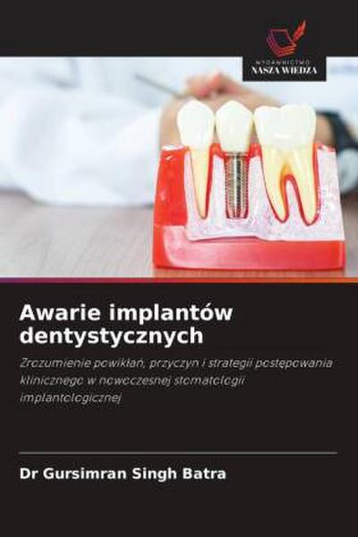 Awarie implantów dentystycznych