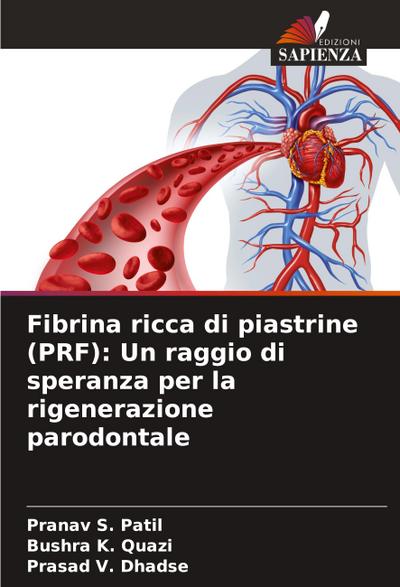 Fibrina ricca di piastrine (PRF): Un raggio di speranza per la rigenerazione parodontale