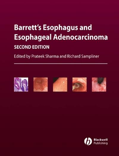 Barrett’s Esophagus and Esophageal Adenocarcinoma
