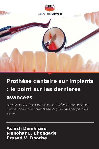 Prothèse dentaire sur implants : le point sur les dernières avancées