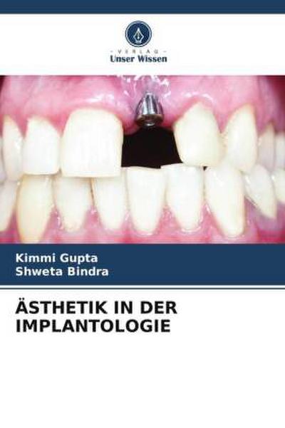 ÄSTHETIK IN DER IMPLANTOLOGIE
