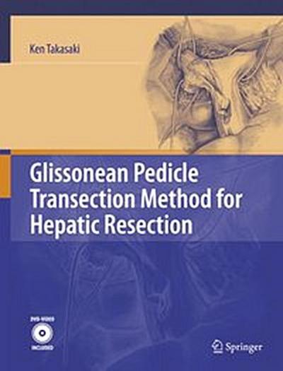 Glissonean Pedicle Transection Method for Hepatic Resection