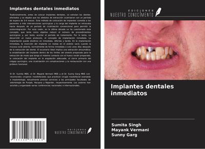 Implantes dentales inmediatos