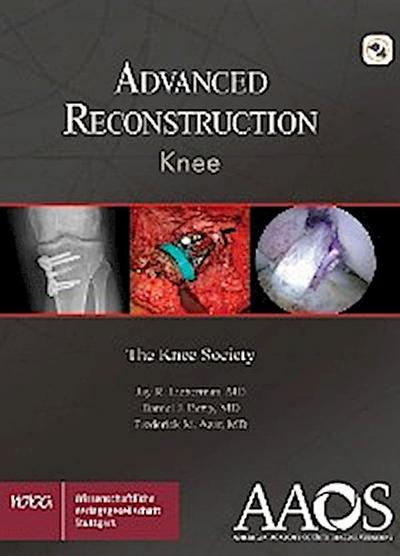 AAOS Advanced Reconstruction Knee