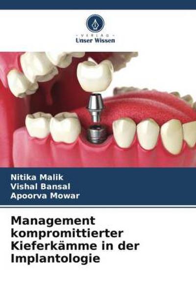 Management kompromittierter Kieferkämme in der Implantologie