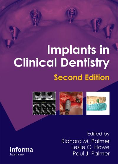 Implants in Clinical Dentistry