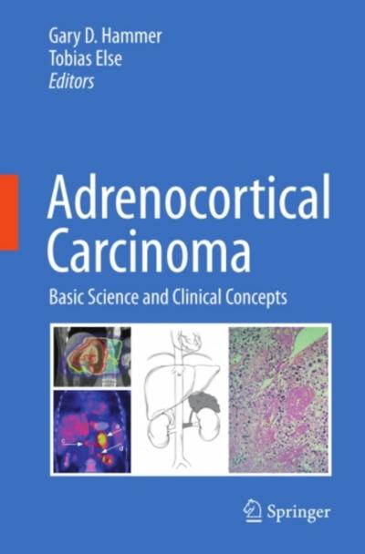 Adrenocortical Carcinoma