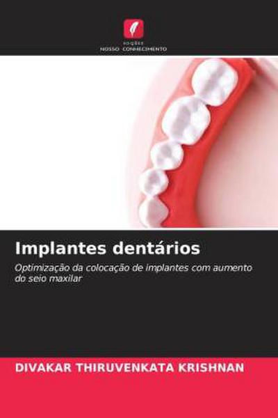 Implantes dentários