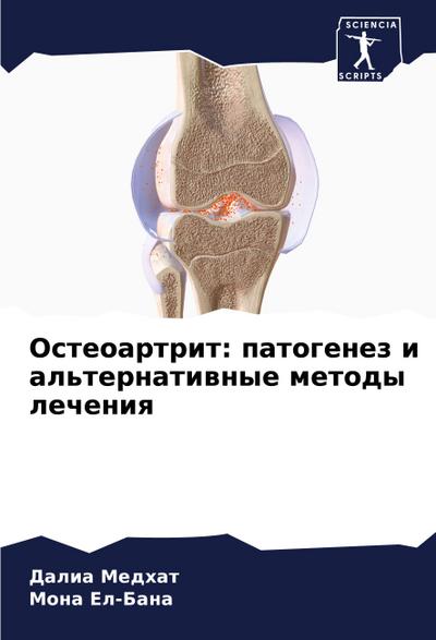 Osteoartrit: patogenez i al’ternatiwnye metody lecheniq