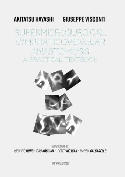 Supermicrosurgical LymphaticoVenular Anastomosis